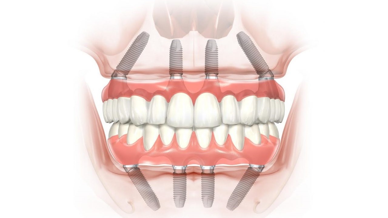 Фото: для дентальной имплантации полной челюсти используют 4 винта