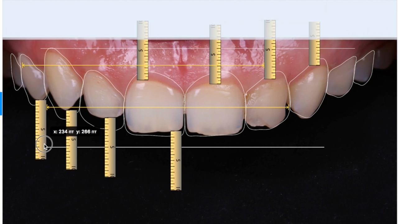 Фото: планирование виниров на передние зубы в специальной компьютерной программе