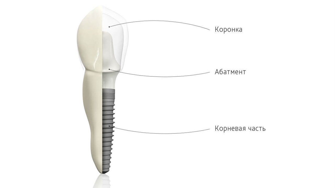 Фото: в современной стоматологии зубы восстанавливают имплантами, которые имеют стандартное строение: винт, абатмент, коронка